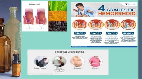 kuntil sa pwet|Hemorrhoids, Fissures. Anal and Rectal Cancer .